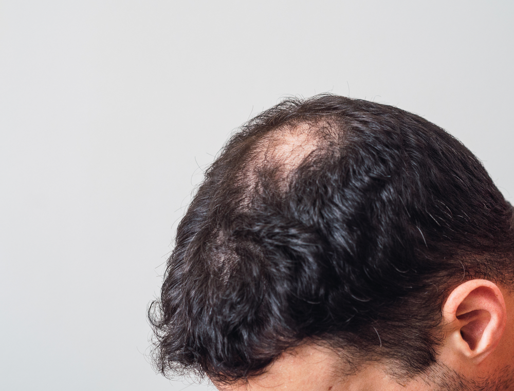 Phenylalanine for Hair Growth: Mechanism of Action